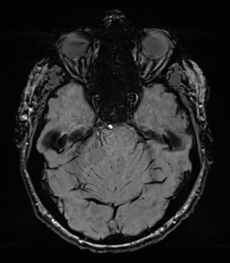 File:Acoustic schwannoma (Radiopaedia 50846-56358 Axial SWI 30).png