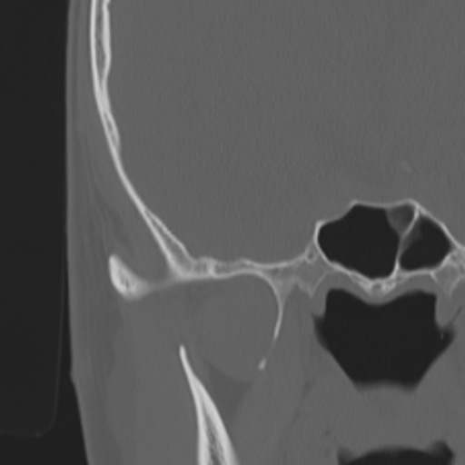 Acoustic schwannoma - eroding petrous apex (Radiopaedia 39674-42002 Coronal bone window 29).png