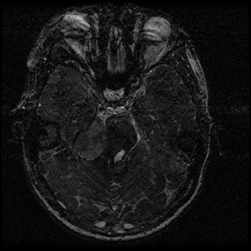 Acoustic schwannoma - eroding petrous apex (Radiopaedia 39674-42004 Axial T2 68).png