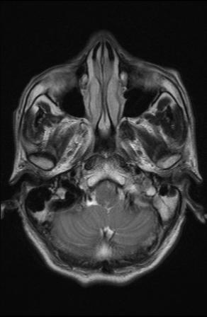 File:Acoustic schwannoma - probable (Radiopaedia 20386-20292 Axial T2 3).jpg