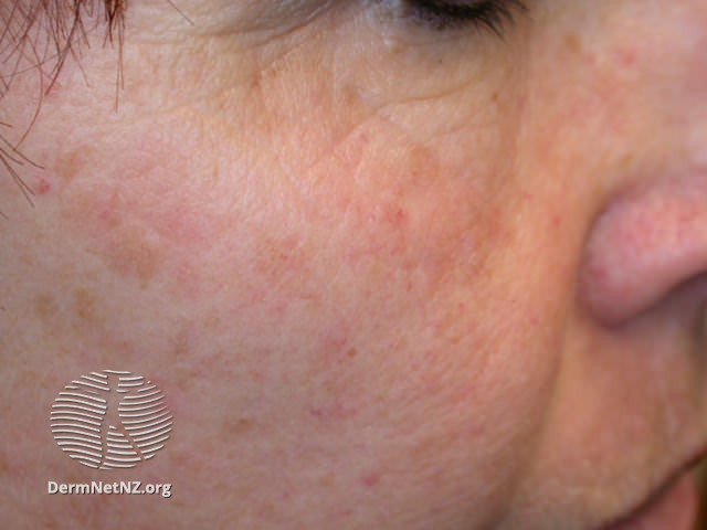 Actinic Keratoses affecting the face (DermNet NZ lesions-ak-face-437).jpg