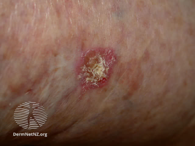 File:Actinic keratosis (DermNet NZ doctors-lesions-images-sk1).jpg