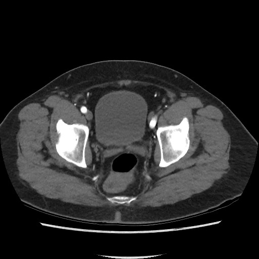 File:Active colonic bleed on CT (Radiopaedia 49765-55025 Axial C+ arterial phase 75).jpg
