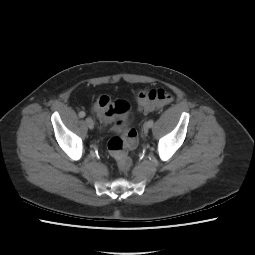 File:Active colonic bleed on CT (Radiopaedia 49765-55025 Axial C+ delayed 70).jpg