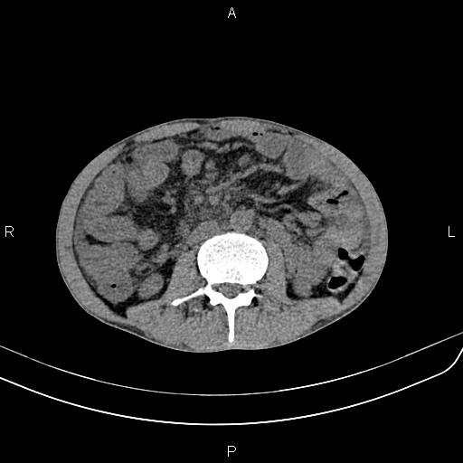File:Active crohn disease (Radiopaedia 87133-103397 Axial non-contrast 51).jpg