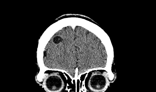 File:Active neurocysticercosis before and after therapy (Radiopaedia 71710-82099 Coronal C+ delayed 17).jpg