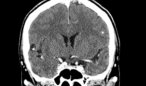 File:Active neurocysticercosis before and after therapy (Radiopaedia 71710-82099 Coronal C+ delayed 35).jpg