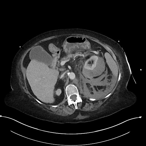 File:Active renal extravasation with large subcapsular and retroperitoneal hemorrhage (Radiopaedia 60975-68796 Axial 283).jpg