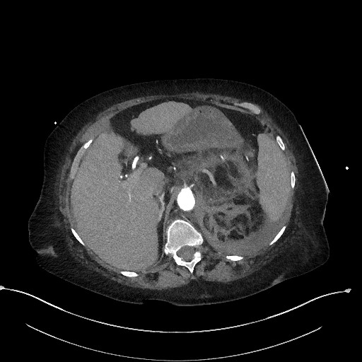 File:Active renal extravasation with large subcapsular and retroperitoneal hemorrhage (Radiopaedia 60975-68796 Axial C+ arterial phase 52).jpg