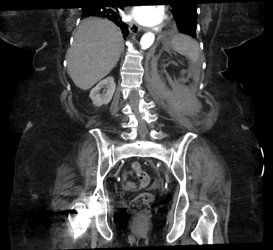 Active renal extravasation with large subcapsular and retroperitoneal hemorrhage (Radiopaedia 60975-68796 Coronal C+ arterial phase 105).jpg