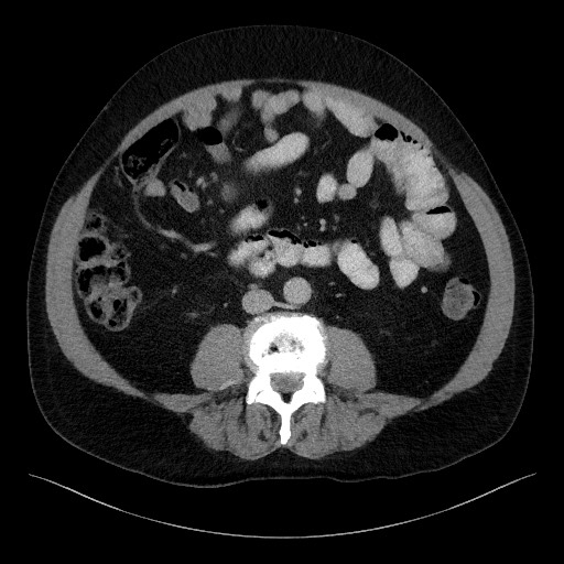 Acute-on-chronic pancreatitis (Radiopaedia 67286-76656 Axial C+ portal venous phase 44).jpg