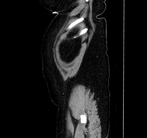 Acute appendicitis, heterotaxy syndrome (Radiopaedia 66884-76202 Sagittal C+ portal venous phase 21).jpg