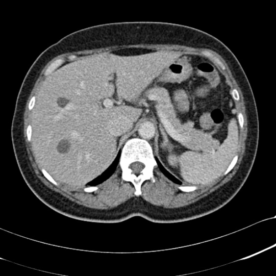 Acute appendicitis (Radiopaedia 48792-53822 Axial C+ portal venous phase 26).jpg