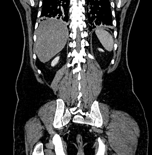 File:Acute appendicitis (Radiopaedia 79950-93224 Coronal C+ portal venous phase 75).jpg