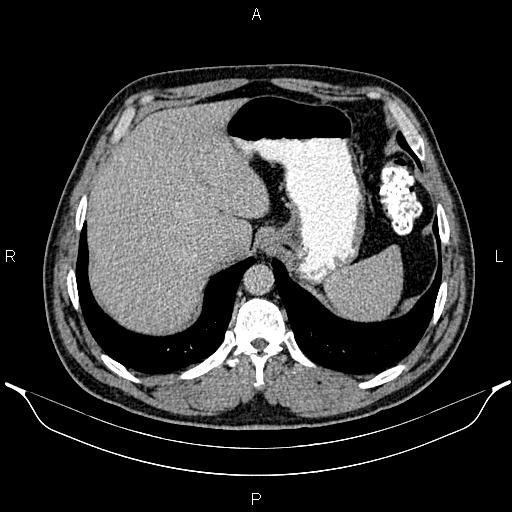 Acute appendicitis (Radiopaedia 84780-100240 Axial C+ portal venous phase 19).jpg