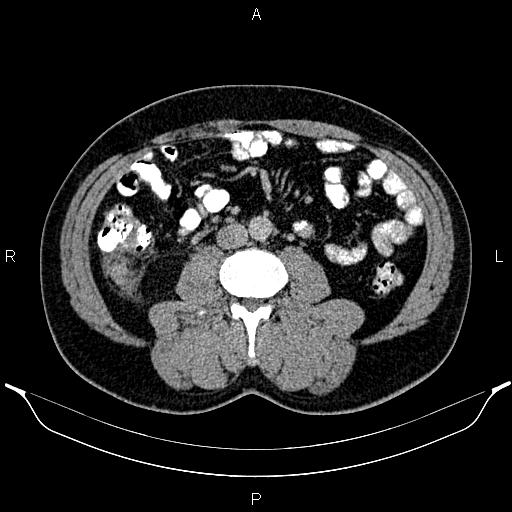 Acute appendicitis (Radiopaedia 84780-100240 Axial C+ portal venous phase 57).jpg
