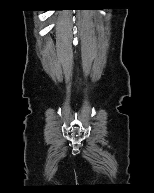 Acute appendicitis - large appendicoliths (Radiopaedia 61805-69820 Coronal C+ portal venous phase 123).jpg