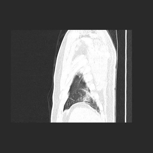 Acute appendicitis and COVID 19 pneumonia (Radiopaedia 76604-88380 Sagittal lung window 86).jpg