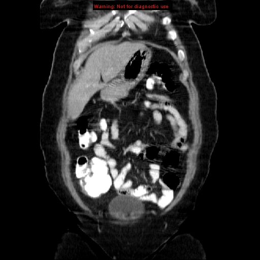 Acute appendicitis complicated by ovarian vein thrombophlebitis (Radiopaedia 16172-15851 Coronal C+ portal venous phase 21).jpg