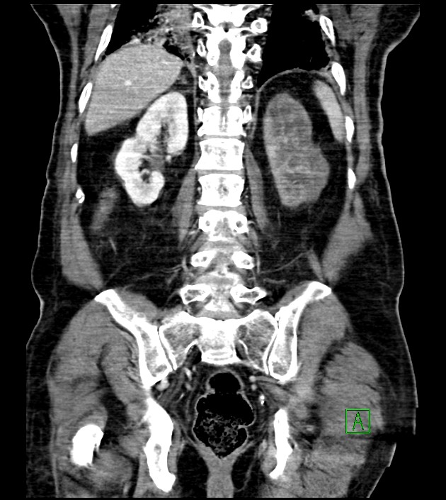 Acute arterial mesenteric ischemia (Radiopaedia 78238-90828 Coronal C+ portal venous phase 68).jpg