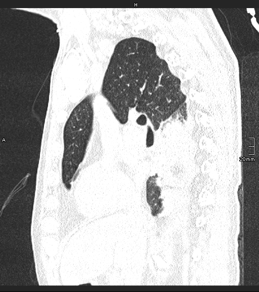 File:Acute aspiration pneumonitis (Radiopaedia 55642-62166 Sagittal lung window 93).jpg