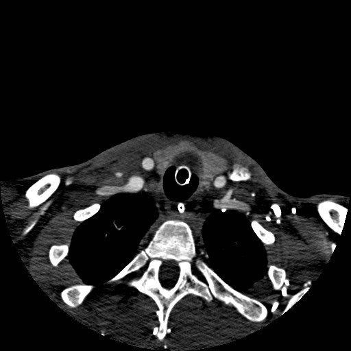 Acute basilar artery occlusion (Radiopaedia 43582-46985 Axial C+ arterial phase 288).jpg