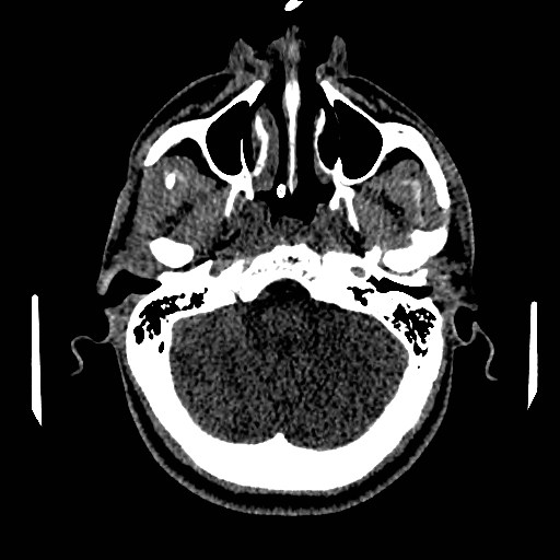 Acute basilar artery occlusion (Radiopaedia 43582-46985 Axial non-contrast 46).jpg