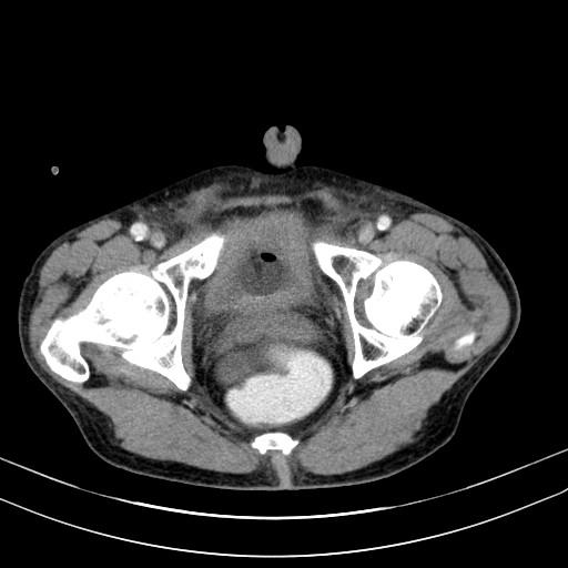 Acute bowel ischemia (Radiopaedia 87695-104114 Axial C+ portal venous phase 82).jpg