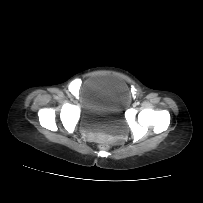 File:Acute calculous cholecystitis in patient with osteopetrosis (Radiopaedia 77871-90159 Axial C+ portal venous phase 73).jpg
