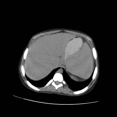 File:Acute calculous cholecystitis in patient with osteopetrosis (Radiopaedia 77871-90159 Axial non-contrast 20).jpg