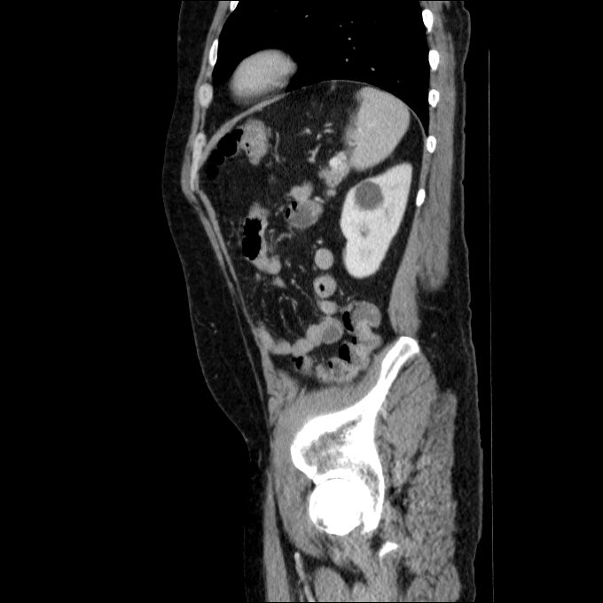 Acute cholecystitis and incidental left sided IVC (Radiopaedia 49352-54459 Sagittal C+ portal venous phase 26).jpg
