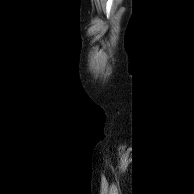 Acute cholecystitis and incidental left sided IVC (Radiopaedia 49352-54459 Sagittal C+ portal venous phase 5).jpg