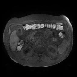 File:Acute cholecystitis complicated by pylephlebitis (Radiopaedia 65782-74915 Axial T1 fat sat 67).jpg