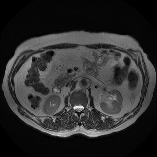 File:Acute cholecystitis complicated by pylephlebitis (Radiopaedia 65782-74915 Axial T2 25).jpg