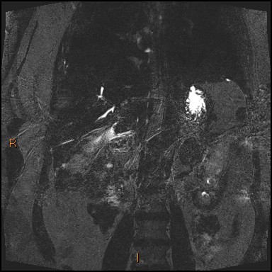 File:Acute cholecystitis with gallbladder neck calculus (Radiopaedia 42795-45971 Coronal Turbo spin echo 11).jpg