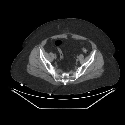 File:Acute cholecystitis with tensile fundus sign (Radiopaedia 71394-81723 Axial non-contrast 94).jpg