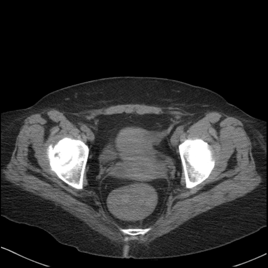 Acute colonic hemorrhage in ulcerative colitis (Radiopaedia 77415-89538 Axial non-contrast 123).jpg