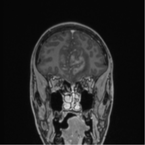 Acute disseminated encephalomyelitis (ADEM) (Radiopaedia 65319-74349 Coronal T1 C+ 50).png