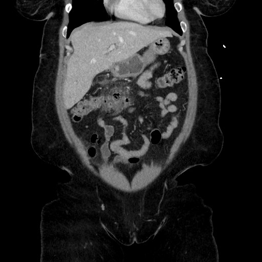 Acute diverticulitis - transverse colon (Radiopaedia 87063-103327 Coronal C+ portal venous phase 57).jpg
