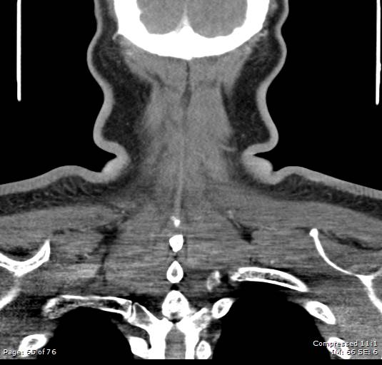 Acute epiglottitis (Radiopaedia 54375-60590 Coronal C+ arterial phase 65).jpg