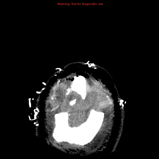 Acute hemorrhagic leukoencephalitis (Radiopaedia 14076-43697 Axial non-contrast 48).jpg