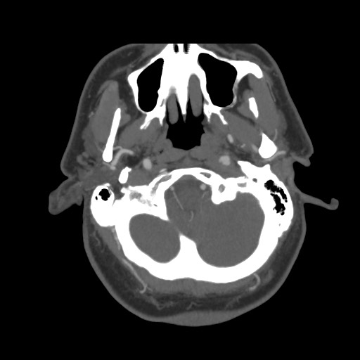 File:Acute internal carotid artery dissection (Radiopaedia 53541-59630 D 10).jpg