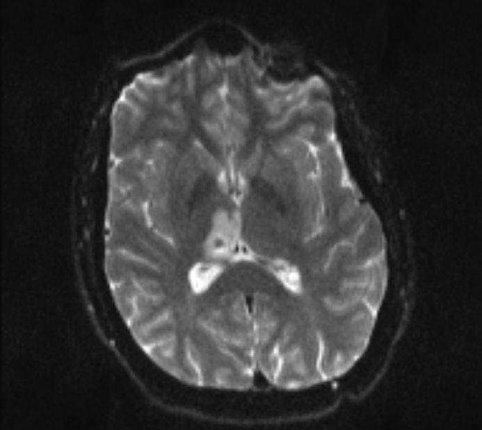 Acute ischemic stroke - posterior circulation territory (Radiopaedia 77670-89880 Axial DWI 13).jpg