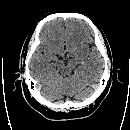 Acute left middle cerebral artery territory ischemic stroke (Radiopaedia 35688-37223 Axial non-contrast 28).png