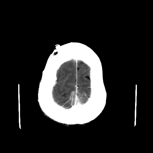 File:Acute necrotizing toxoplasma encephalitis (Radiopaedia 10683-11150 C+ arterial phase 5).jpg