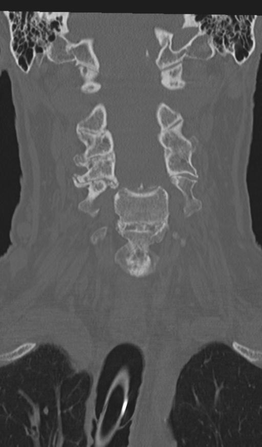 Acute on chronic subdural hematoma and thoracic vertebral injury in a multitrauma patient (Radiopaedia 31698-32619 Coronal bone window 24).jpg