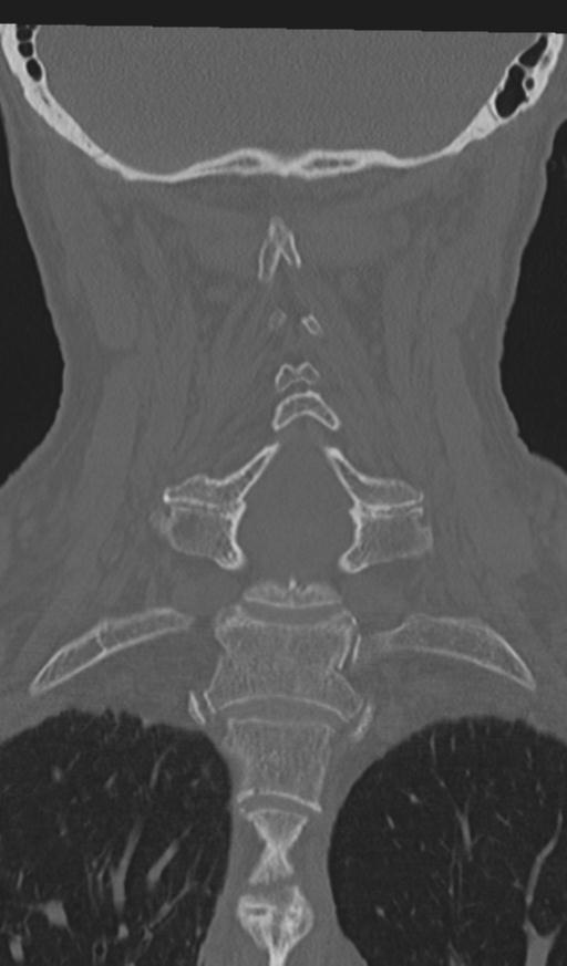 Acute on chronic subdural hematoma and thoracic vertebral injury in a multitrauma patient (Radiopaedia 31698-32619 Coronal bone window 39).jpg
