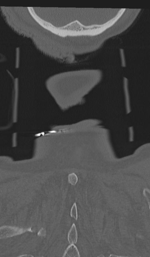 Acute on chronic subdural hematoma and thoracic vertebral injury in a multitrauma patient (Radiopaedia 31698-32619 Coronal bone window 72).jpg