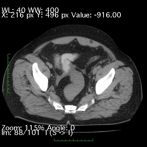 Acute pancreatitis (Radiopaedia 34043-35276 Axial non-contrast 88).jpg