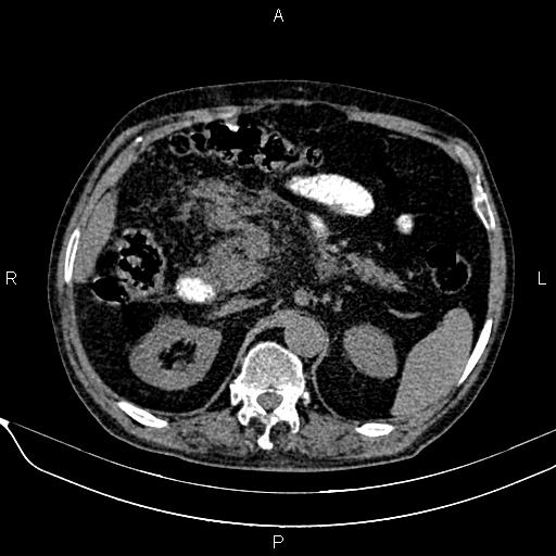 Acute pancreatitis (Radiopaedia 85146-100701 Axial non-contrast 44).jpg